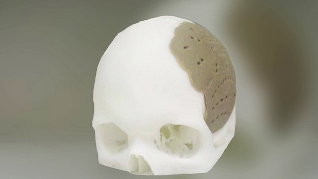 in 3D xương sọ, in 3D mảnh xương lắp ghép chỉnh hình